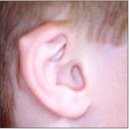 선천성 외이 기형[congenital malformation of external ear] 이미지