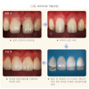 이정치과기공소 네이버블로그