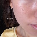 아토스커피 | 여의도 피부과 모공주사 내돈내산 후기