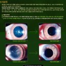 백내장 총정리 이미지