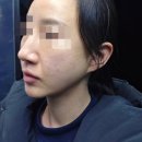 ㈜분당제일에너지 | [분당/정자] 분당정자동피부과에서 티타늄리프팅 받은 내돈내산 후기