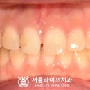 라이프 치과기공소 네이버블로그