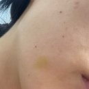 쁘띠365의원 | 춘천 “쁘띠 365” 리쥬란 통증부터 앰보싱 자국1주차 후기까지 솔직 리뷰(feat. 정품여부)