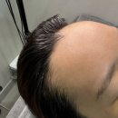 강남무통헤어라인 투엠메이크업 M자 이마 내돈내산 반영구 후기