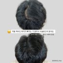 국제두피탈모