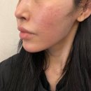 아란 | 한남동 피부과 mct 줄기세포 아란셀 시술 일주일차 후기 (통증 , 다운타임)