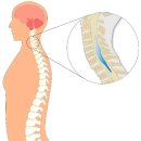 Re: 척수 공동증 정형외과, 신경외과적 문제들 탐구!! 이미지