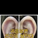 이혈(귀) 상담과 건강관리 이미지