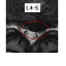 아이리벗 님의 요추디스크 L4-5의 MRI 사진 판독입니다. [4급 판정] 이미지