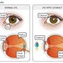 [봄의약속안과] 백내장 수술 후 관리방법 (강동구백내장,송파구백내장) 이미지