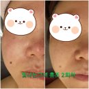 진건오남로781-17 | 별내에스테틱&gt;안면홍조 레이저 후기 보다 더 후기 좋은 홍조개선