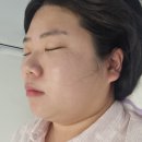은계동물병원 | [시흥 체형/피부관리] 세레누 제로브이 후기 : 이중턱 지방분해 &amp; 브이라인 리프팅 리얼체험 후기