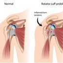 어깨의 통증, 회전근개손상을 의심해보세요.! 이미지
