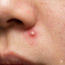 비전중앙약국 | 코밑에 뾰루지 원인 코옆 코안 코 주변에 여드름 피부관리 없애는법