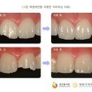 앞니 등 이 깨졌을 때 치과 레진 치료 가능한 종류 및 좋은 점, 복합레진 치아 수복에 최선 이미지