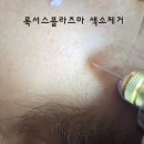 플라즈마 색소제거 온뷰티with페디크루 #화성플라즈마 #동탄플라즈마 #피부관리 이미지