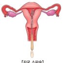 계류유산[missed abortion]이란? 이미지