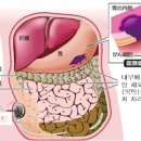 복막암 증상 원인 복수 말기 4기 생존율 투석 검사방법 이미지