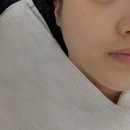 300 | 대구 피부과 [리니어지 300샷] 리프팅 후기