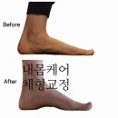 척추측만, 오다리 교정 성공한 실제 후기