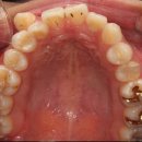 송파다이아튼튼의원 | 토끼처럼 튀어나온 앞니 부분교정, 설측교정으로 4개월 걸린 후기. 부분교정 가능할까 기준