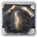 스타헤어 | [일산/백석] 일산두피문신 블랙스타스칼프 방문후기, 헤어라인교정의 모든 것