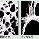 골다공증.bmp 이미지