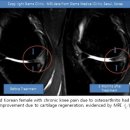 퇴행성 관절염, 지방줄기세포 치료효과 입증 이미지