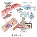 샤가스병[Chagas disease]감염성 질환 이미지