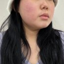 창원 | 창원상남동피부과후기 온다리프팅 효과 좋아요. 전후사진 내돈내산