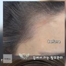 림 스칼프 | 바쁜 일상 속 탈모 고민, 전문가가 추천하는 가장 확실한 '3주 홈케어' 법! [림발 3주 후기]