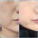 V-9 | 인천 콜라겐볼륨부스터 에버클V 볼륨+리쥬란2cc 2주 효과 후기