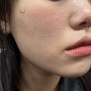 신사역 피부과 신사 세레아의원 인모드 모피우스 리프팅 모공 변화 후기