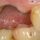 동탄연세원구강악안면외과치과의원 | 구강 내 통증의 원인은 무엇일까? 동탄호수공원 치과 임플란트 과정