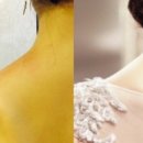 [D-43] 종아리 보톡스...너무아팠어요 / 보톡스부작용 / 보톡스확산성
