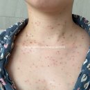 이채 | (내돈내산) 편평사마귀와 쥐젖 온몸 무제한 제거 후기_365이채한의원 부산대연점