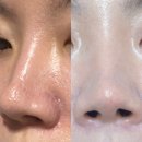 스킨모아 | 신사역피부과 후기) 쥬베룩스킨 + 포텐자 펌핑팁 / 후관리 중요!! 전후사진 비교