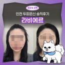 P-6929 | 인천두피문신 라비에르 | SMP 헤어라인 교정 솔직후기