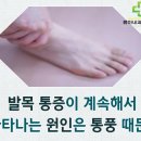 발목 통풍 증상 저리다면 의심해봐야 이미지