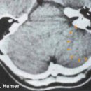 FEMALE BREAST - 유방선 이미지