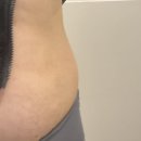 수원한의원 | 수원 인계동 한의원 지방 분해주사 후기