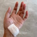 천안제일약국 | [천안] 순천향대학병원에서 손바닥 점 제거 수술받고 온 후기 3탄