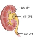 광주비뇨기과의원 | 구토와 옆구리 통증을 동반한 요로결석 입원 후기