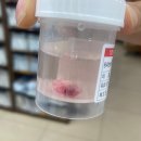 피지낭종수술, 피부과는 못한다하고 성형외과는 비싸서 찾은 병원후기