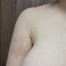 (주)미백 | 담소유병원 부유방수술 후기 &amp; 부유방 수술 한 달 차 &amp; 미백연고 &amp; 흉터 크림 &amp; 고주파 치료