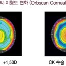 밝은눈안과 고주파 노안 시력교정술 이미지