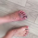 헬스장 골절 사고 / 발가락골절 수술 후기 ... 3개 골절