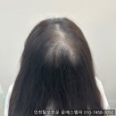 부천 두피숱채움, 자연스러움이 살아있는 곳을 찾는다면