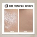 그리미아빌딩 | 배곧피부관리 구은희에스테틱 잡티지우개로 편평사마귀 싹 지움 (+2주후기)