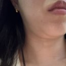 멍 | 강남역 온다 인모드 리프팅 2주 후기 (멍,붓기 효과 대박)